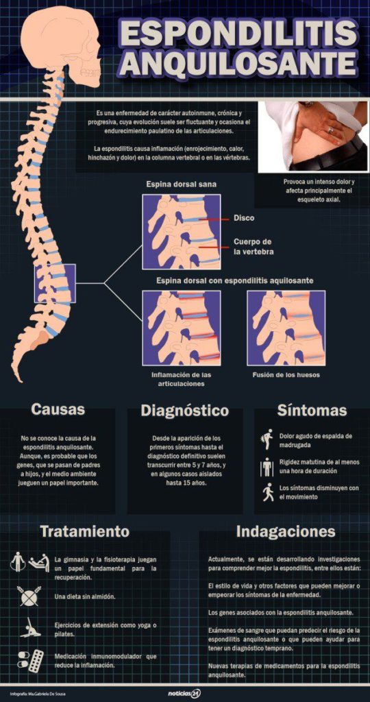 Espondilitis anquilosante #infografia #salud