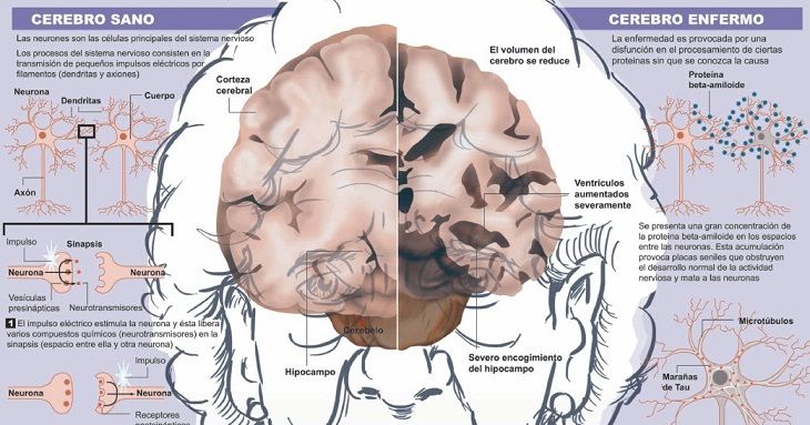 Alzheimer, un lobo al que hay que enfrentar sin miedos