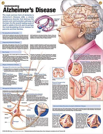 Understanding Alzheimer