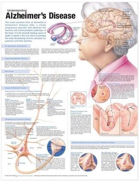 Understanding Alzheimer