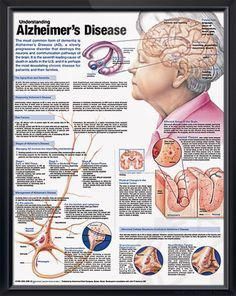 Understanding Alzheimer's Disease anatomy poster discusses the aging brain, ...