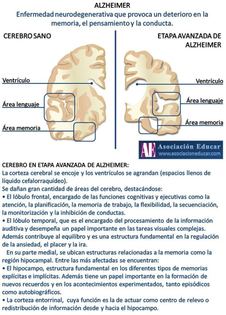 Infografía Neurociencias: Alzheimer.  Material de uso libre, sólo se pide cita...