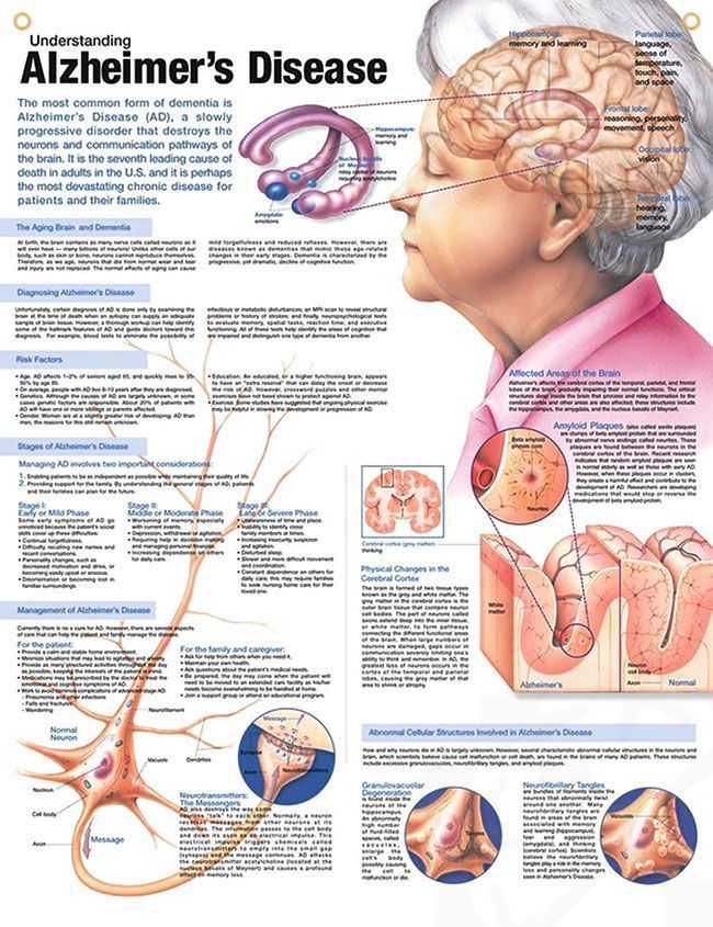 Understanding Alzheimer's Disease Chart 20x26