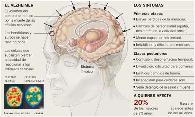 Infografia alzheimer laredinformacion