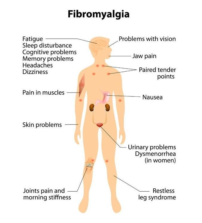 Fibromyalgie