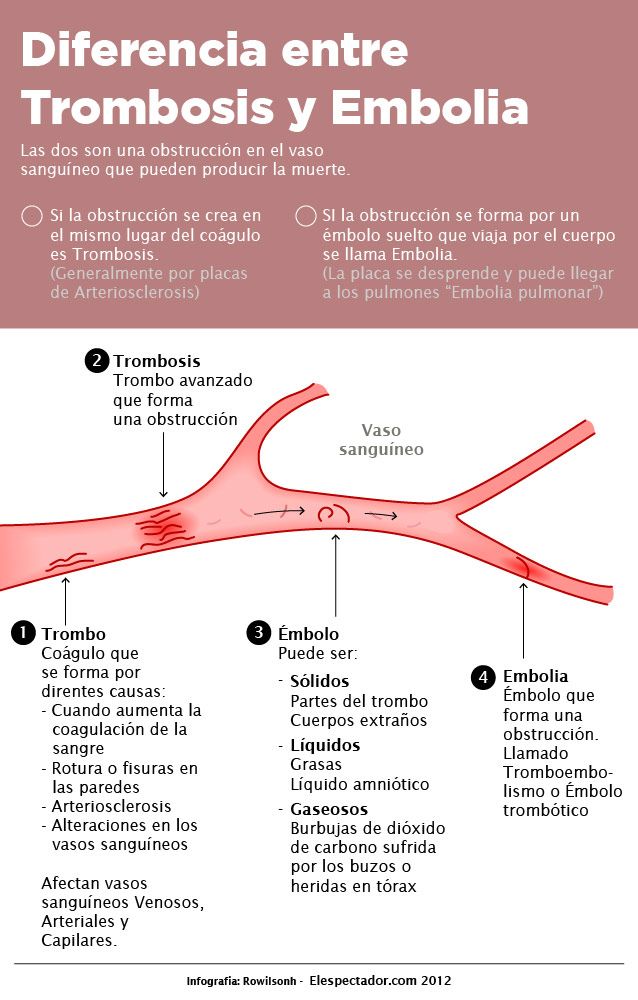 Diferencia entre trombosis y embolia #infografia #infographic #health