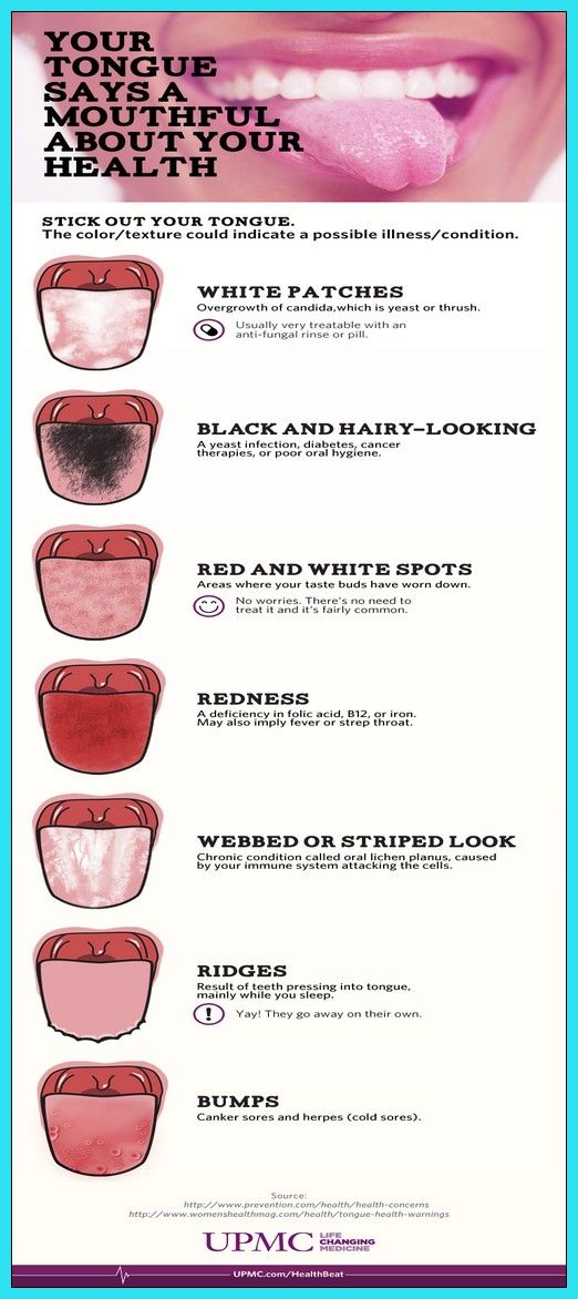 What Does Your Tongue Say About Your Health?