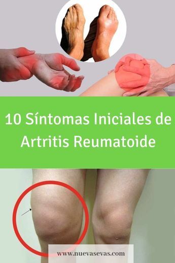 Artritis Reumatoide: 10 síntomas iniciales | Nuevas Evas