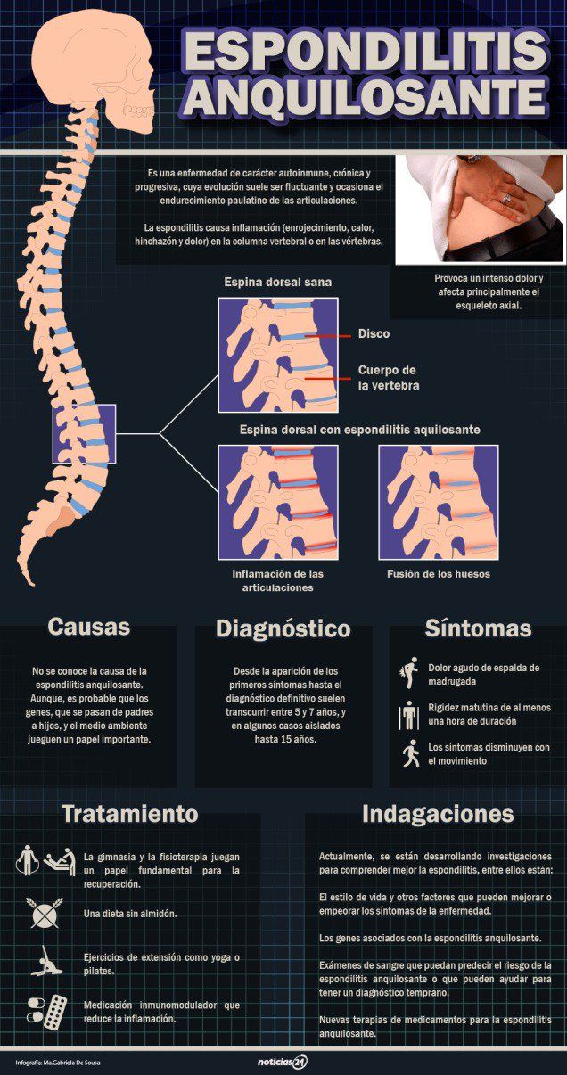 Espondilitis anquilosante #infografia