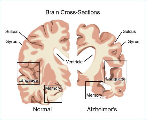 #alzheimer #demencia