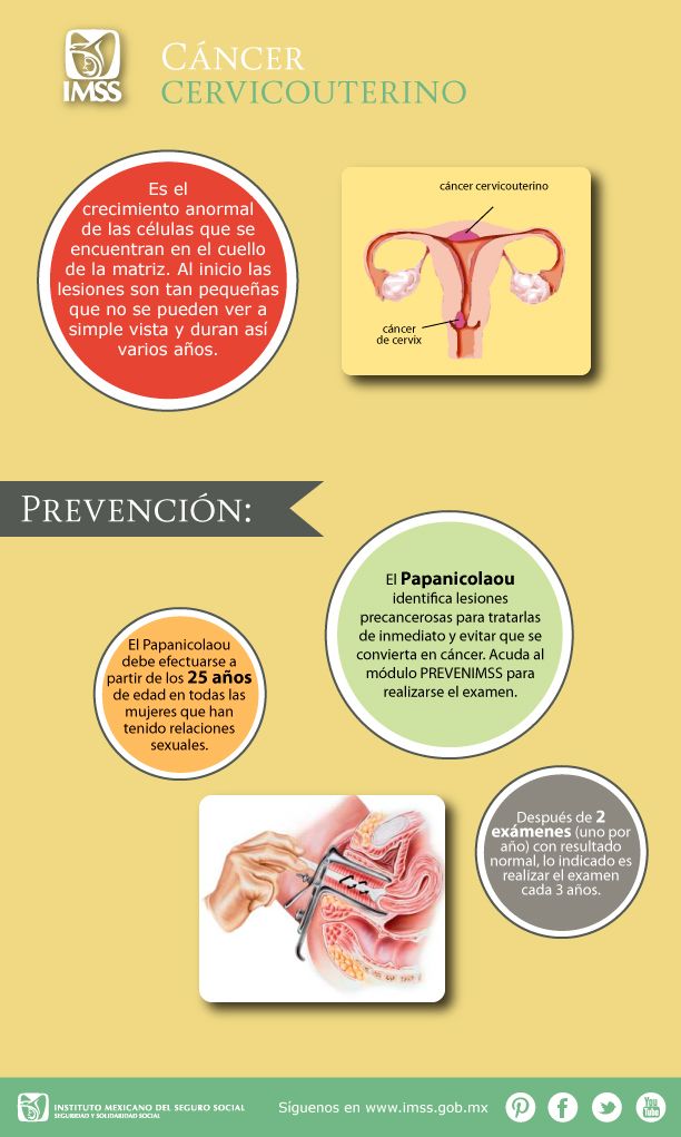 Infografía, Cáncer Cérvico Uterino