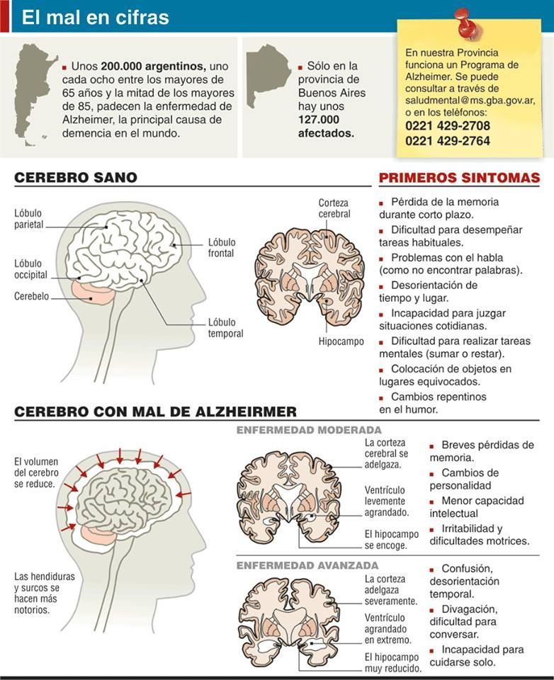 alzheimer infografia