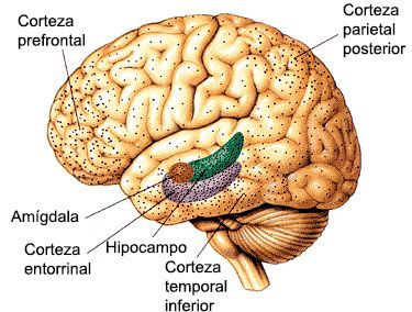 Demencias corticales: Alzheimer, Pick, cuerpos de Lewy y atrofias lobares