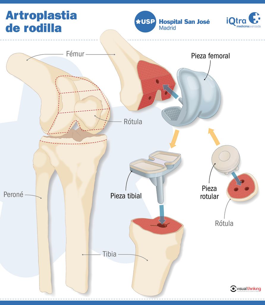 Artroplastia de rodilla #infografia #infographic #salud