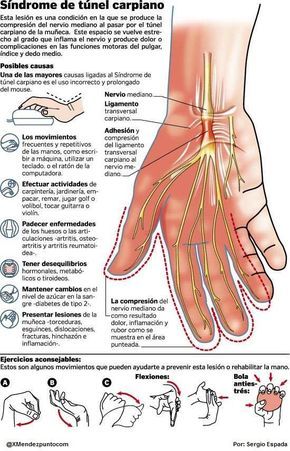 Síndrome del túnel carpiano #infografia #infographic #health