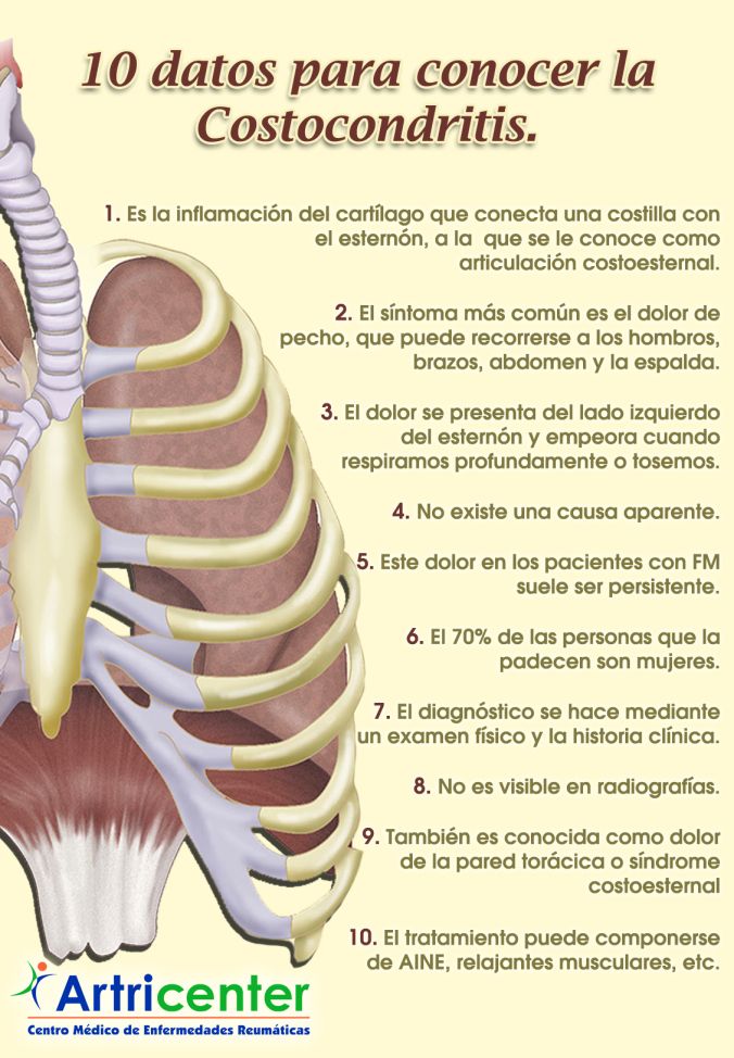 Conoce la Costocondritis en 10 datos