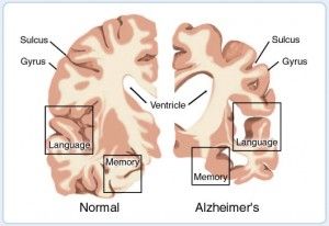 A possible breakthrough in Alzheimer's treatment