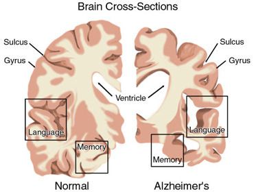 Doença De Alzheimer e Tratamento Fisioterápico