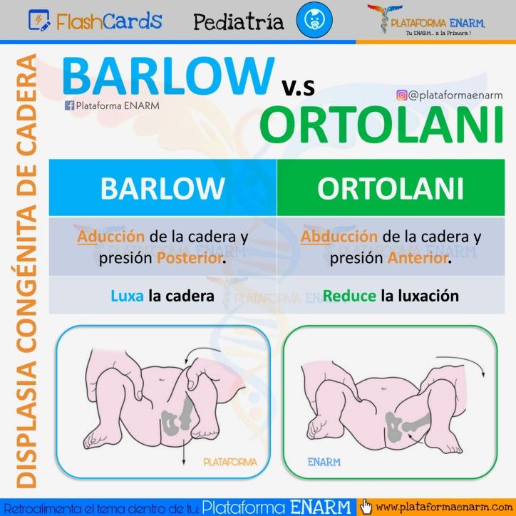 DISPLASIA CONGÉNITA DE CADERA BSRLOW V.S OTOLANI 🧬