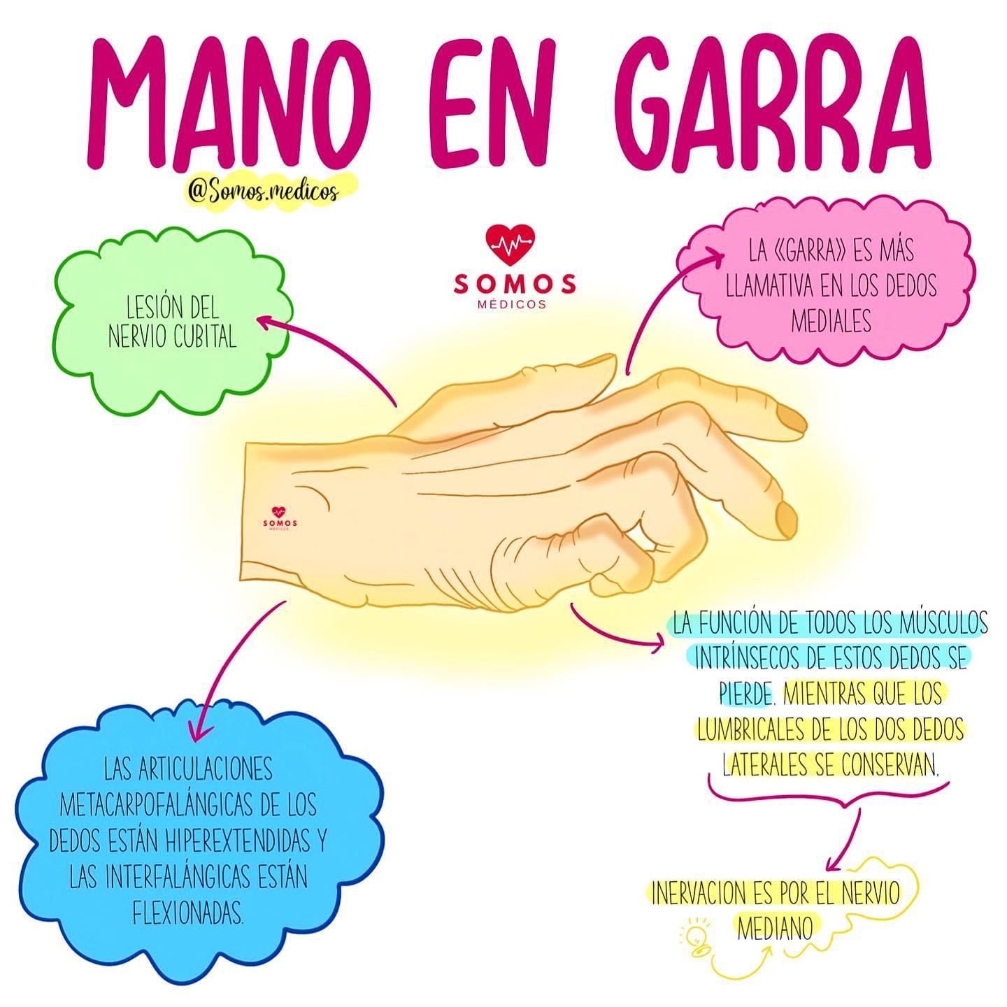 Mano en garra