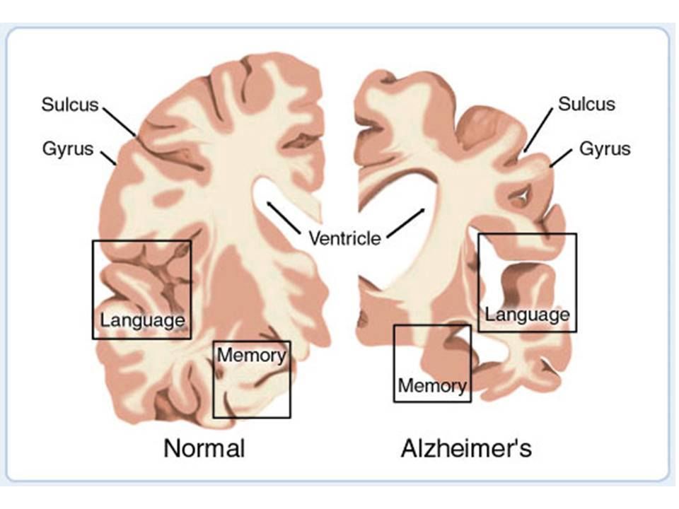 Is Your Parent Showing Signs Of Alzheimer's? How To Tell... - BlackDoctor.org - Where Wellness & Culture Connect