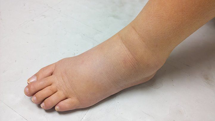 Edema: Symptoms, Causes, Treatments