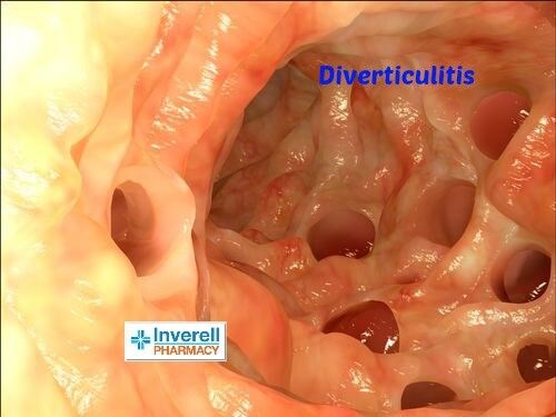 Diverticulitis – How to Treat It