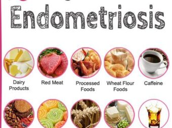 Endometriosis Specialists | Treatment for Endometriosis Pain – #Infografia #Alzheimer #Demencias