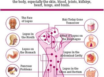 The Effects of Lupus on the Body – #Infografia #Alzheimer #Demencias