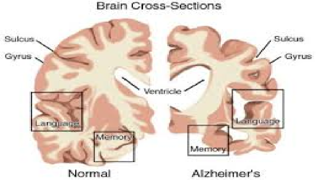 Alzheimer battaglia su tre fronti / Alzheimer's battle on three fronts.