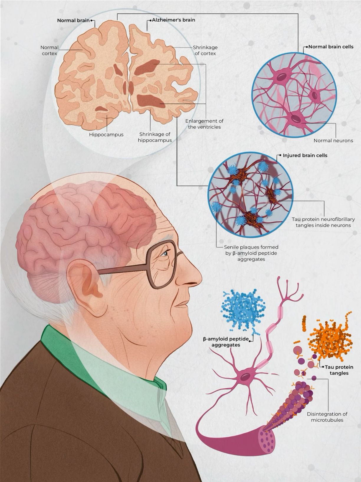 Alzheimer’s Disease Scheme