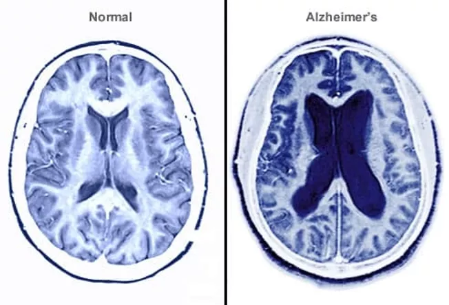 When a Loved One Has Alzheimer's Disease