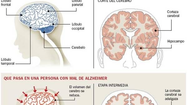 Alzheimer: prueban con éxito un método para detectarlo antes